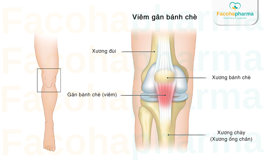 Viêm gân bánh chè đầu gối