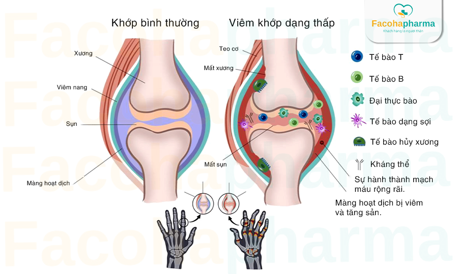 Viêm xương khớp dạng thấp