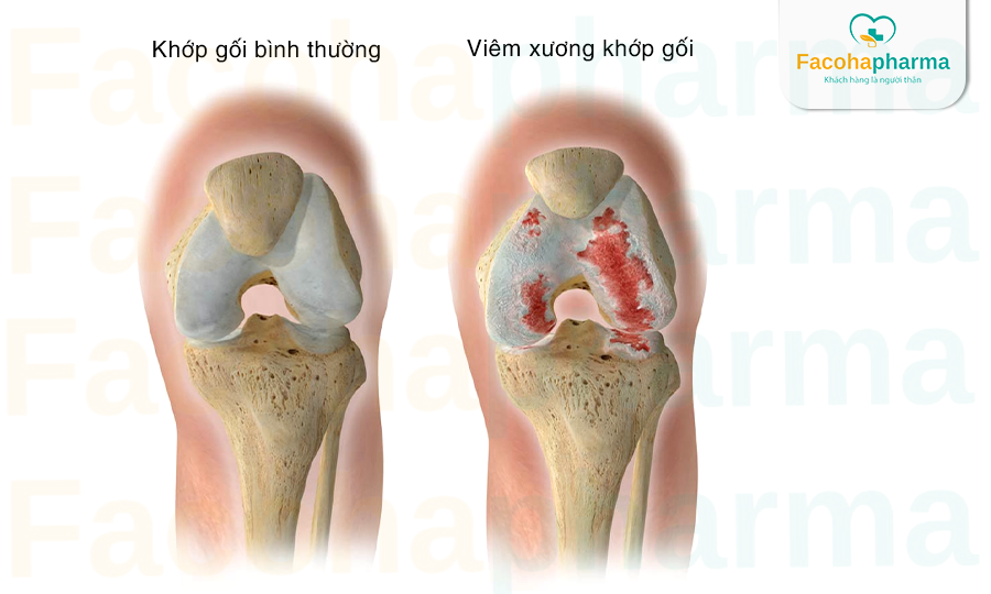 Viêm xương khớp gối