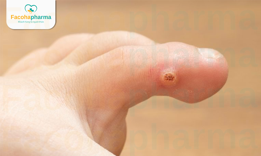 Mụn cóc là gì?