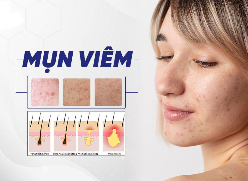 Mụn viêm là gì? Nguyên nhân và cách tiêu diệt các ổ mụn viêm