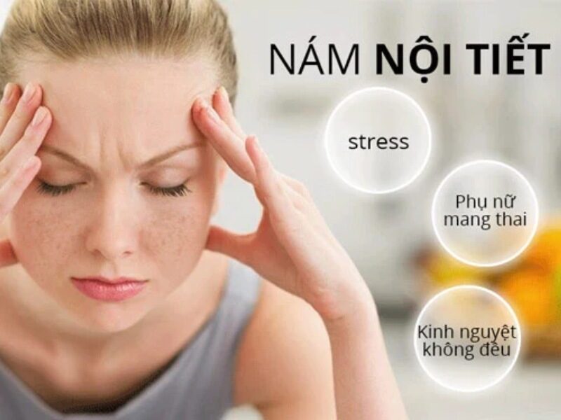 Nám nội tiết là gì? Nguyên nhân và cách điều trị nám da do nội tiết