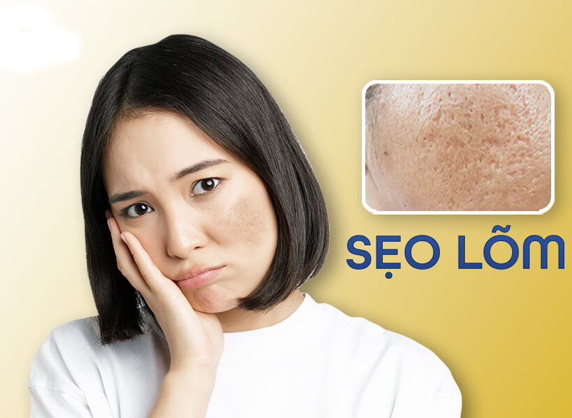 Bật mí kinh nghiệm trị sẹo lõm lâu năm từ chuyên gia