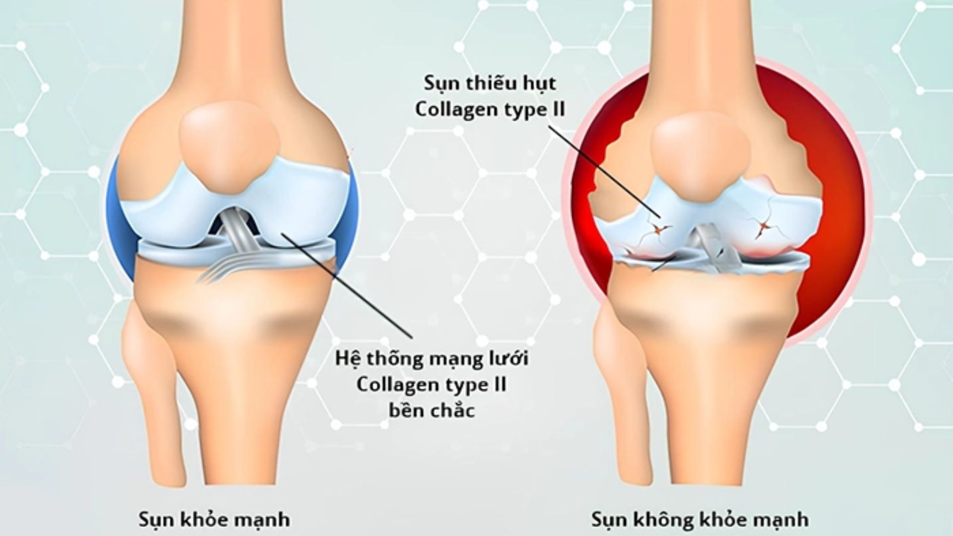 Ai Nên Uống Collagen Type 2? Người Bị Thoái Hóa Khớp Có Nên Dùng?