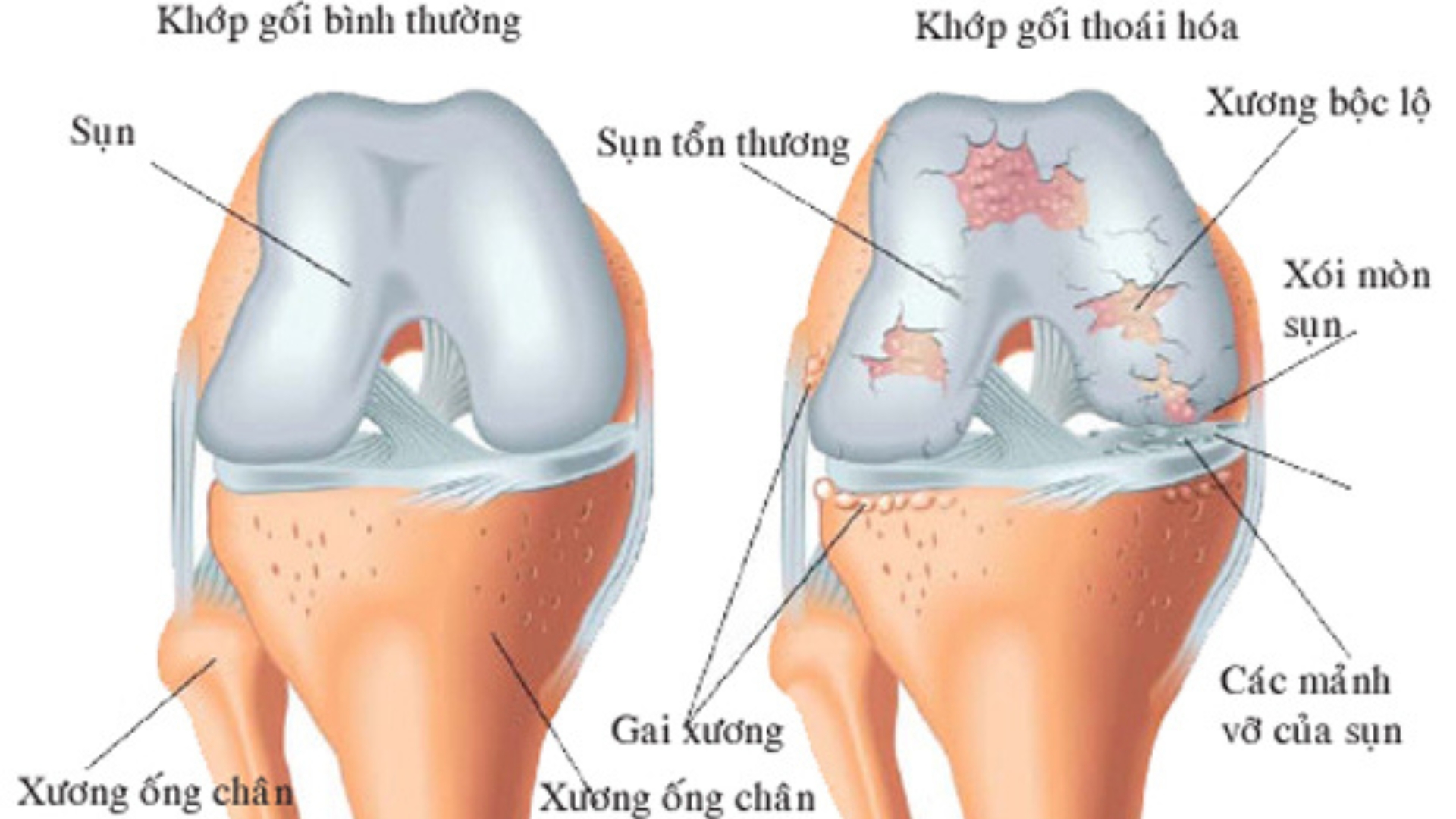 Bị Đau Nhức, Khô Khớp Gối Nên Bổ Sung Gì Để Hỗ Trợ Cải Thiện ?