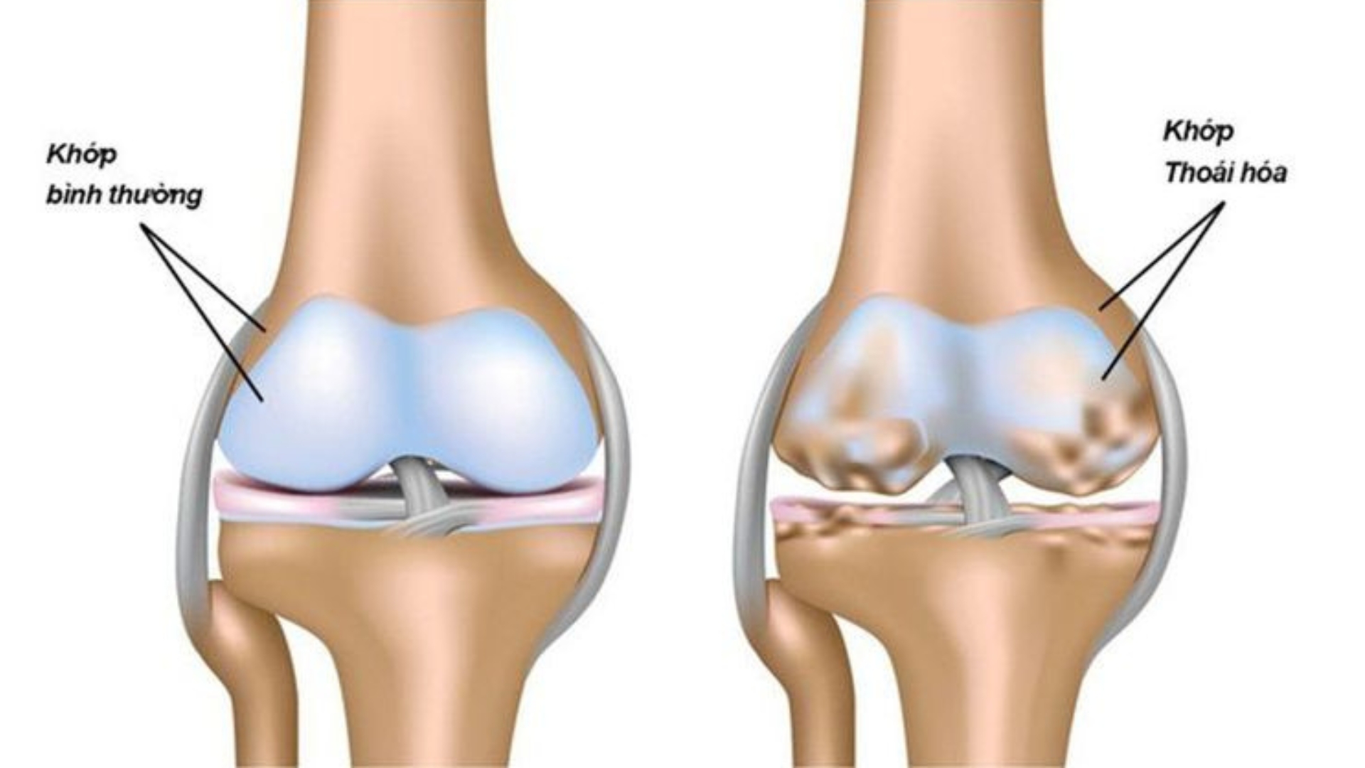 Glucosamine Là Gì Và Có Tác Dụng Như Thế Nào Đối Với Sụn Khớp ?