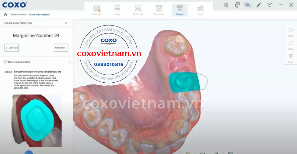 Máy scan trong miệng COXO DL-300P - Thiết bị quét 3D kỹ thuật số nha khoa tiên tiến COXO Intra Oral Scanner - DL-300P