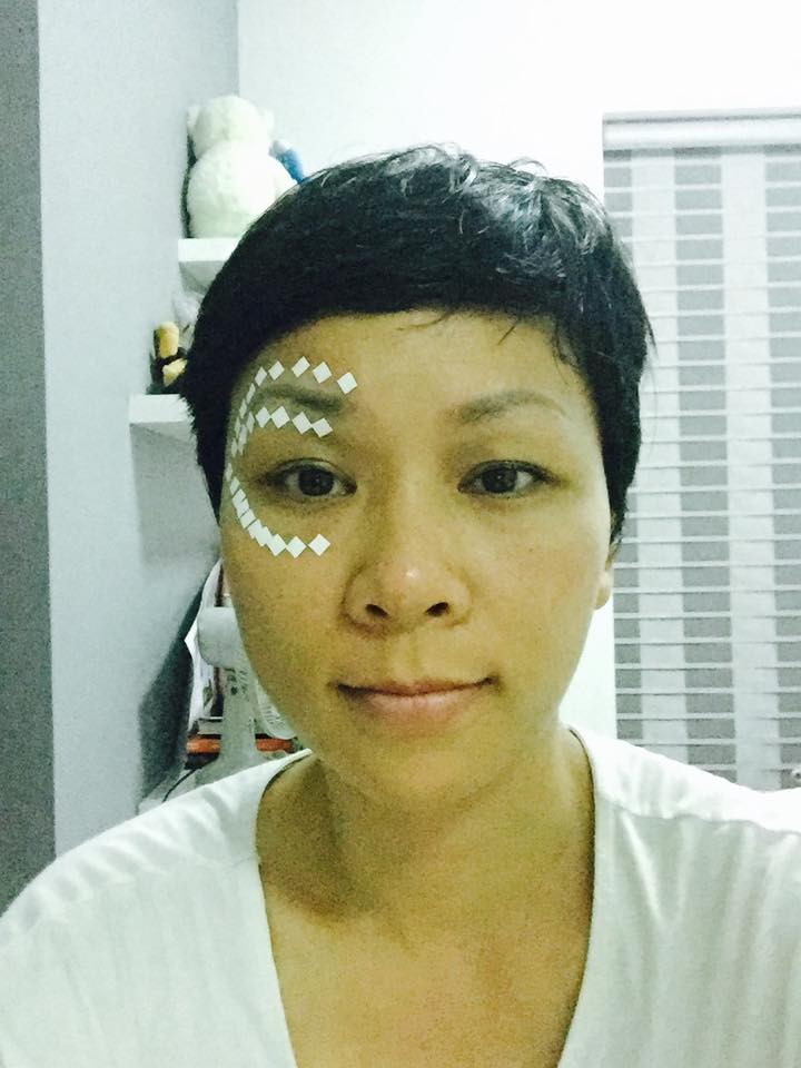 Dán cao Salonpas theo cách của Diện Chẩn thế nào cho đúng