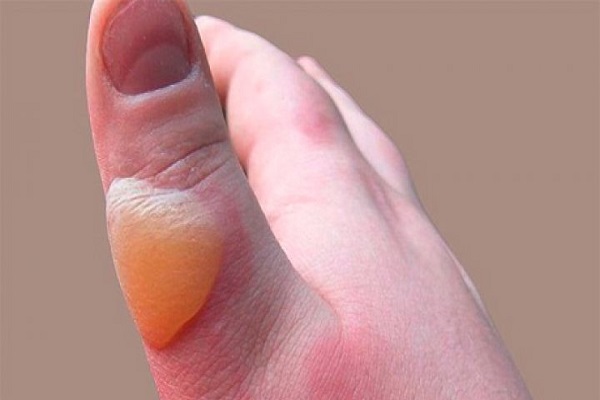 Diện Chẩn Bùi Quốc Châu xử lý bỏng nước sôi