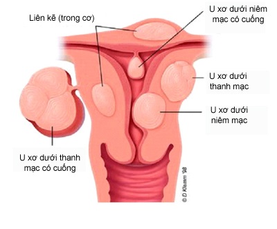 U XƠ TỬ CUNG CÓ ĐÁNG LO?
