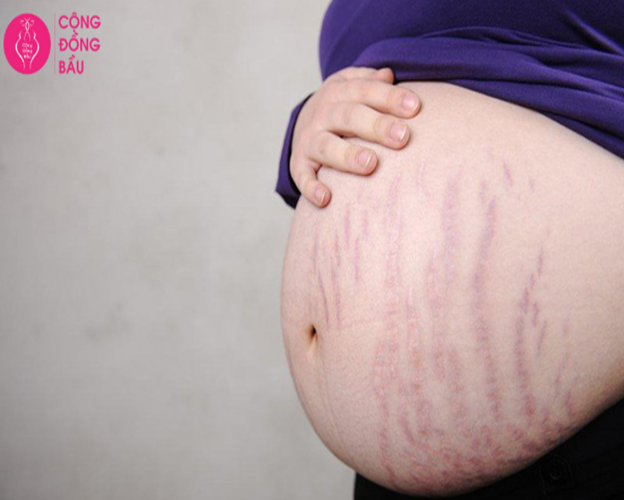 Rạn da ở Phụ nữ mang thai và cách khắc phục