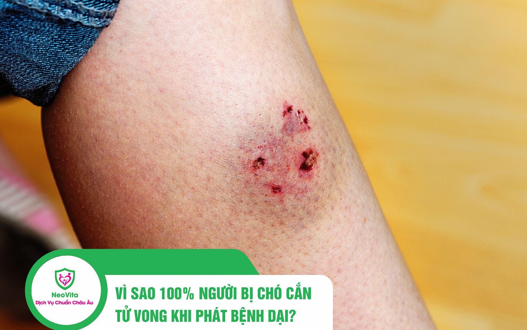 Vì Sao 100% Người Bị Chó Cắn Tử Vong Khi Phát Bệnh Dại?