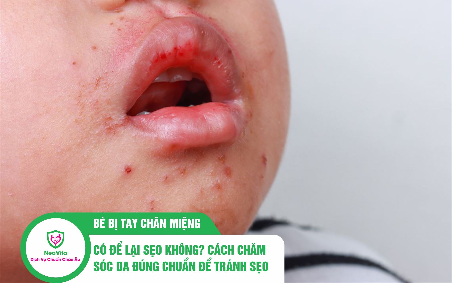 Bé bị tay chân miệng có để lại sẹo không? Cách chăm sóc da đúng chuẩn để tránh sẹo