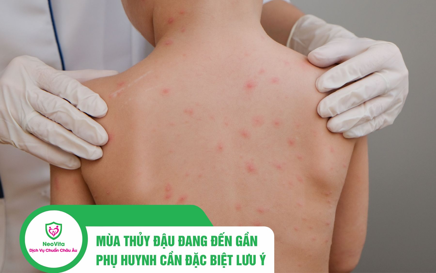 MÙA THỦY ĐẬU ĐANG ĐẾN GẦN, PHỤ HUYNH MẦM NON – TIỂU HỌC CẦN ĐẶC BIỆT LƯU Ý