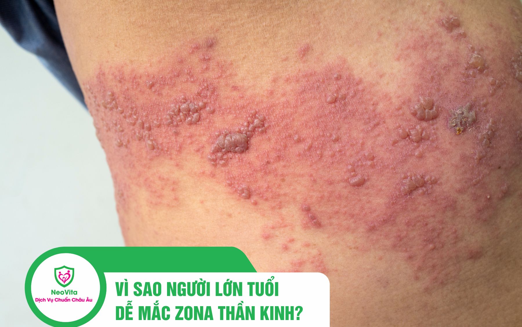 VÌ SAO NGƯỜI LỚN TUỔI DỄ MẮC ZONA THẦN KINH?