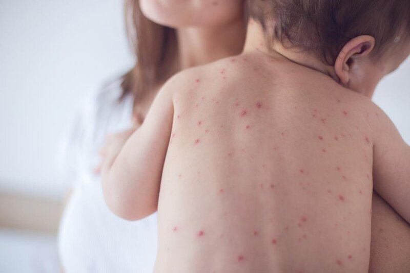 Vacxin sởi có những loại nào và những lưu ý khi tiêm