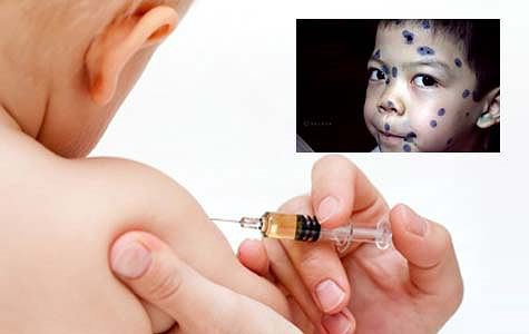 Giá tiêm ngừa thủy đậu là bao nhiêu và tiêm ở đâu uy tín ?