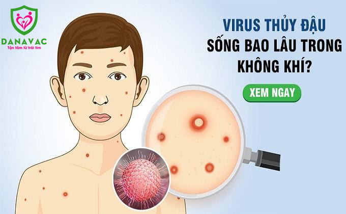 Virus thủy đậu sống bao lâu ngoài môi trường