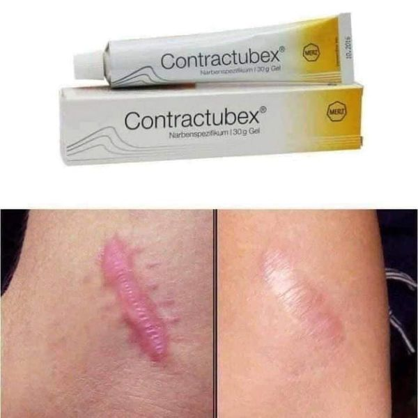 Kem trị sẹo Contractubex