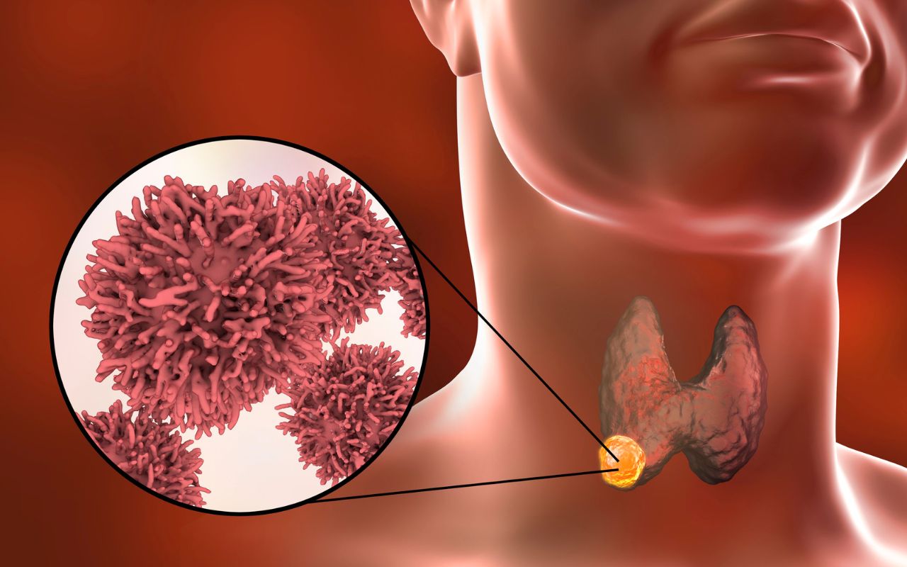 Điều Trị Ung Thư Tuyến Giáp Giai Đoạn 1: Phác Đồ & Tiên Lượng