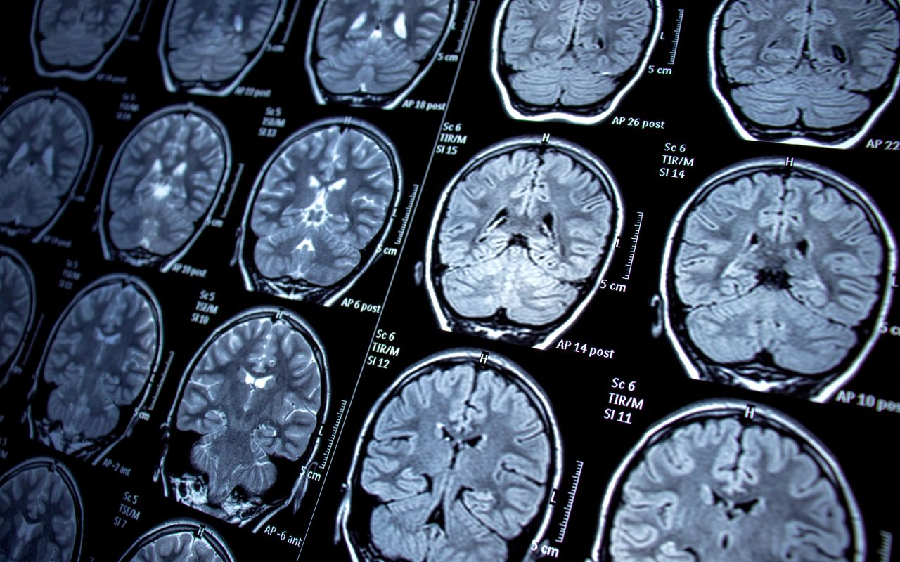 Rối Loạn Thần Kinh Nên Ăn Gì? Hỗ Trợ Chức Năng Não