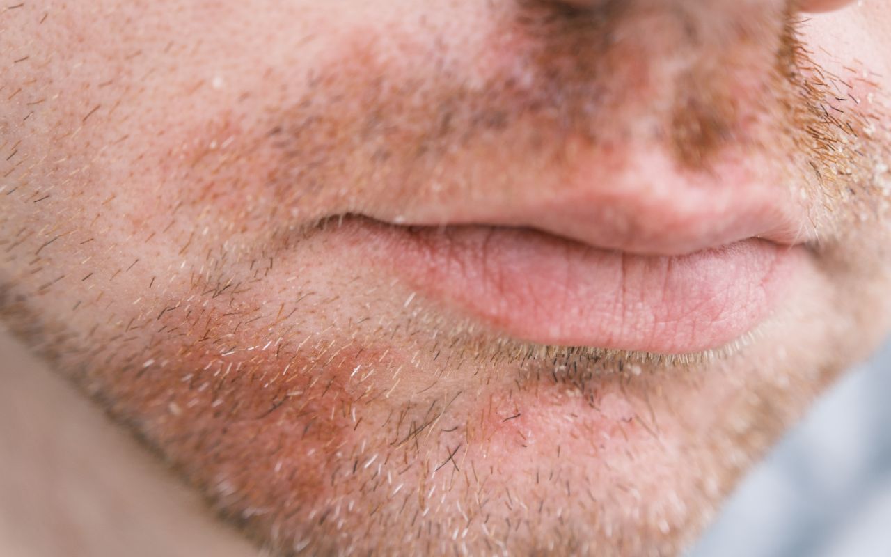 Viêm Da Tiết Bã Nên Ăn Gì? Thực Phẩm Giảm Viêm Da