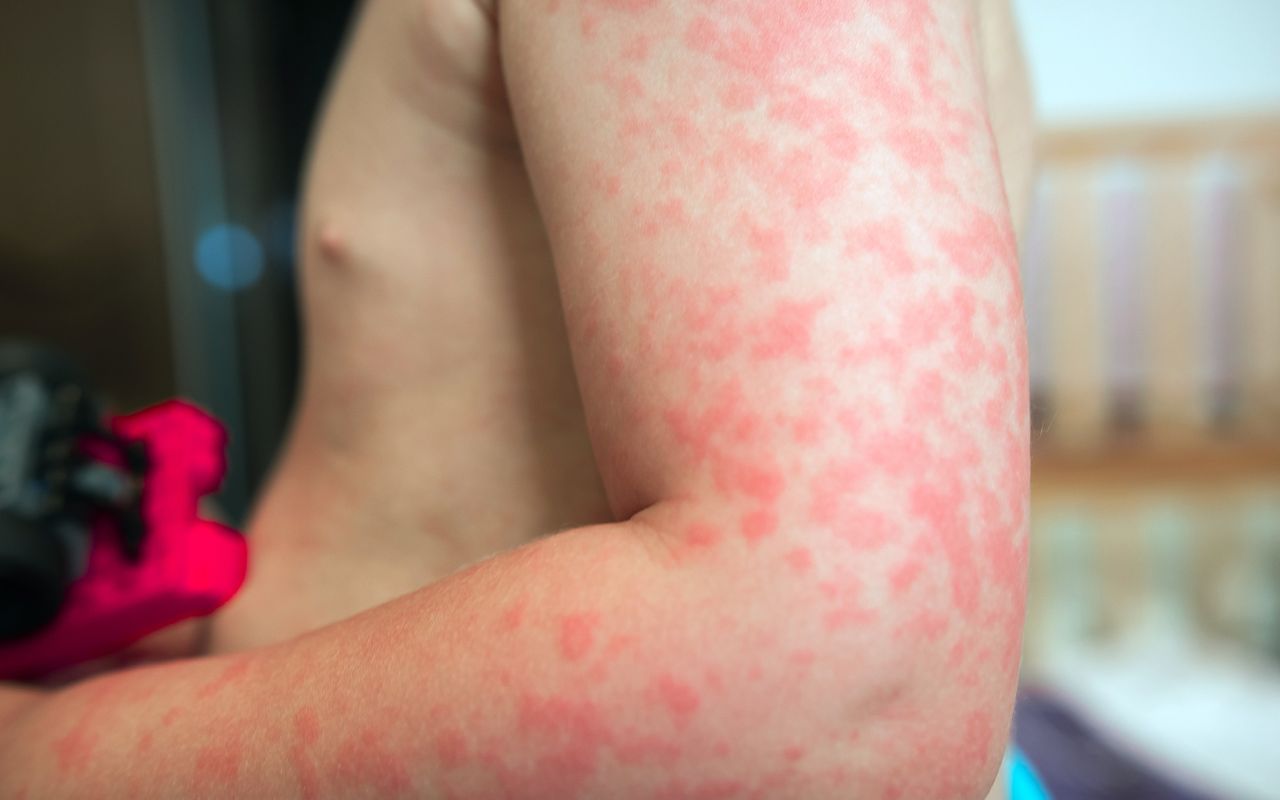 Dị Ứng Thức Ăn Nên Ăn Gì? Bí Quyết Giảm Phản Ứng Dị Ứng Từ Bếp