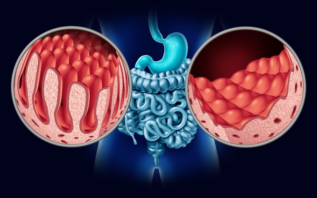 Bệnh Celiac Nên Ăn Gì? Thực Đơn Tránh Gluten Hiệu Quả