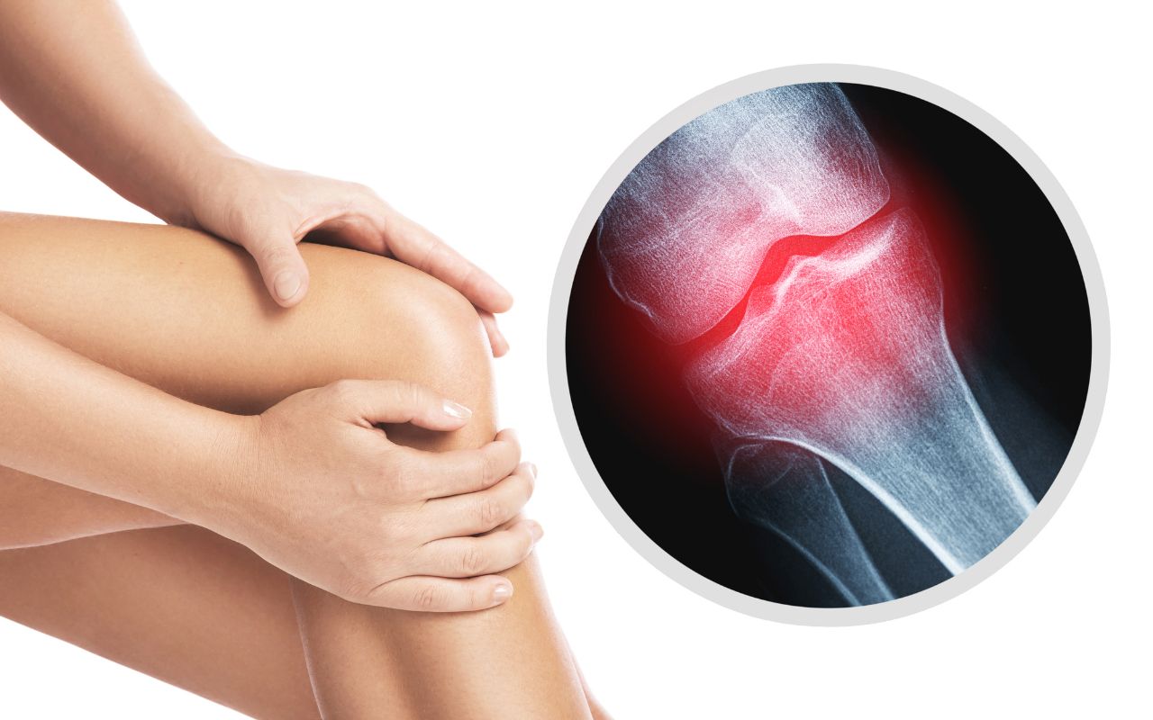 Viêm Khớp Thoái Hóa Nên Ăn Gì? Thực Đơn Giảm Viêm