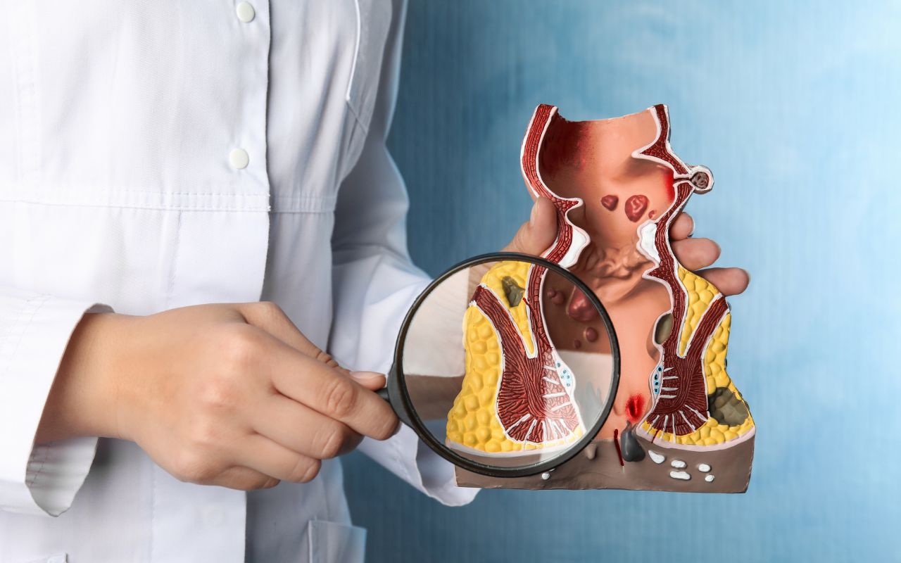 Bệnh Trĩ Nên Ăn Gì? Thực Đơn Cải Thiện Triệu Chứng