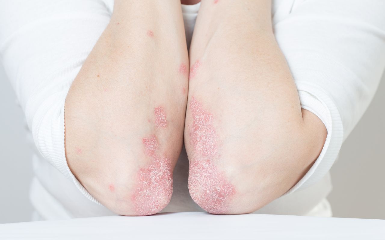 Viêm Khớp Vảy Nến Nên Ăn Gì? Thực Phẩm Giảm Viêm Tốt