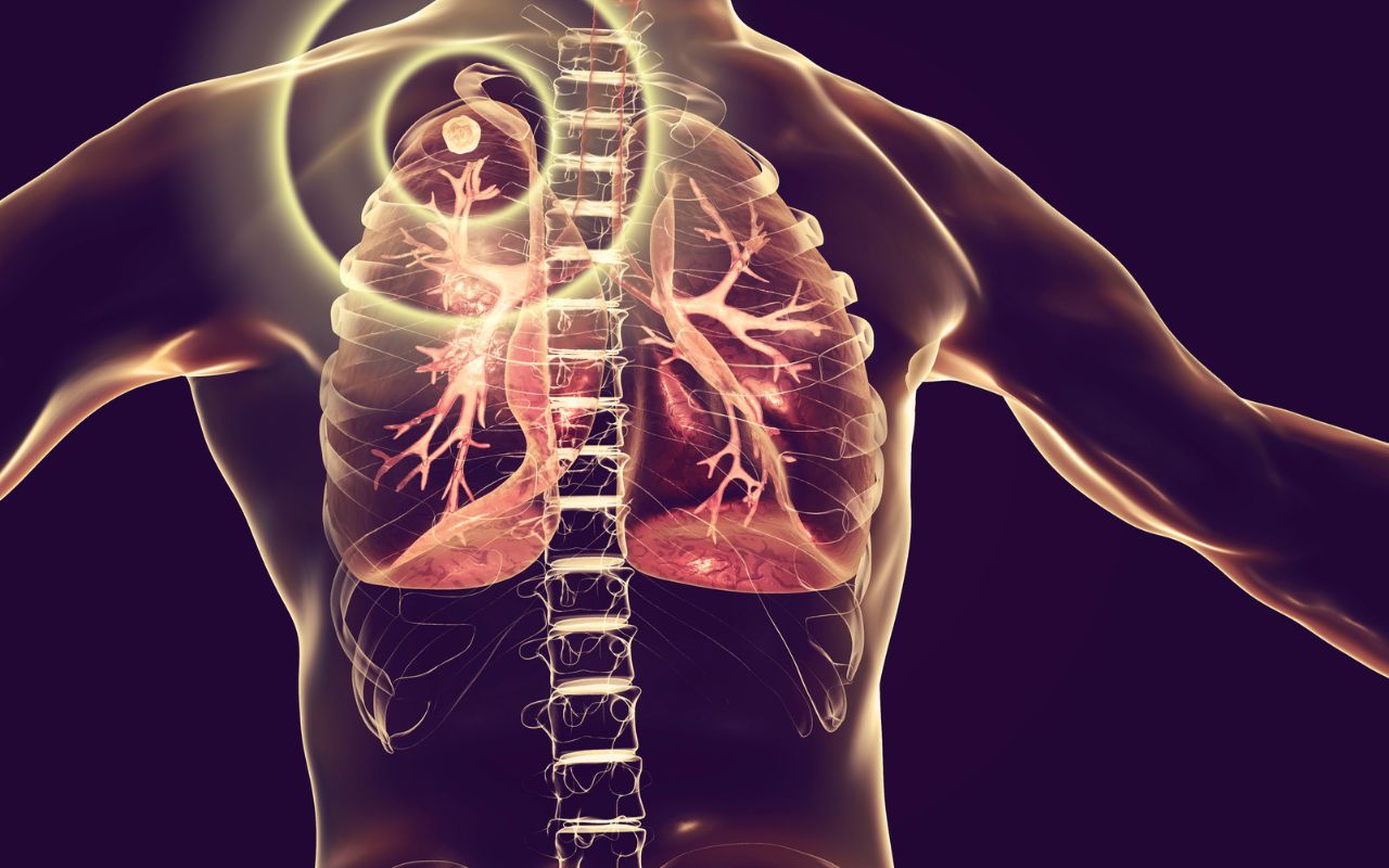 Lao Phổi Nên Ăn Gì? Thực Đơn Hỗ Trợ Điều Trị Hiệu Quả