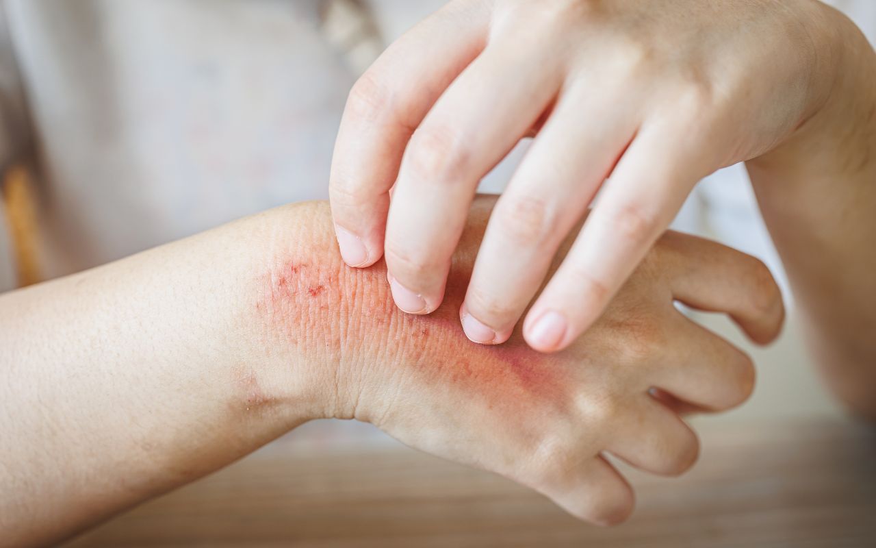 Nấm Da Nên Ăn Gì? Thực Phẩm Cải Thiện Sức Khỏe Da