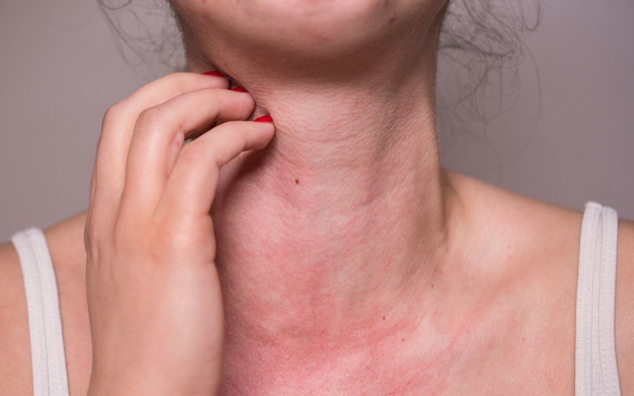 Dị Ứng Nên Ăn Gì?