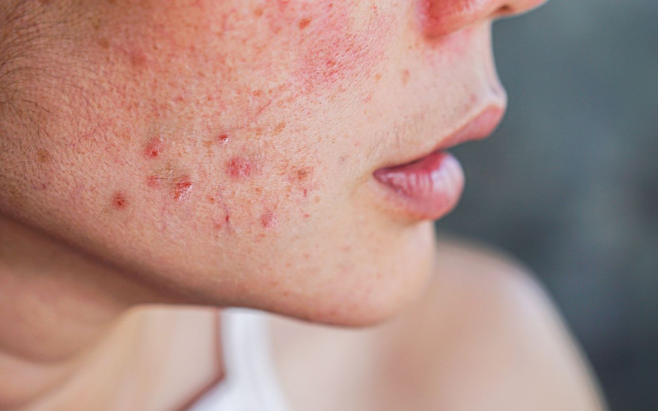 Mụn Trứng Cá Nên Ăn Gì? Thực Phẩm Giảm Mụn Hiệu Quả