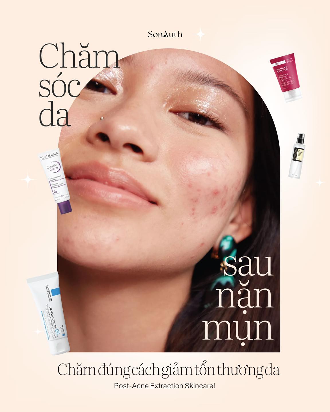 Chăm sóc da sau nặn mụn đúng cách Chăm sóc da sau nặn mụn đúng cách