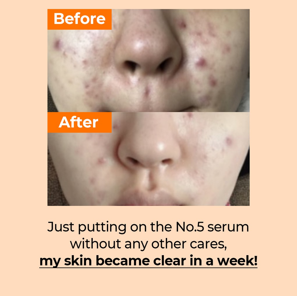 Tinh Chất Numbuzin No.5+ Vitamin Concentrated Serum 30ml