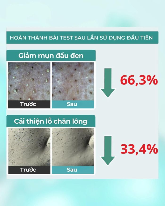 Dung Dịch Sạch Mụn Đầu Đen Jumiso Blackhead Melting Softener Special Kit