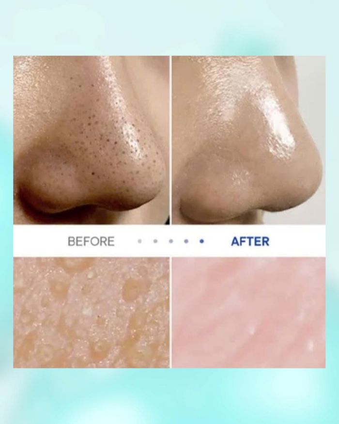 Dung Dịch Sạch Mụn Đầu Đen Jumiso Blackhead Melting Softener Special Kit