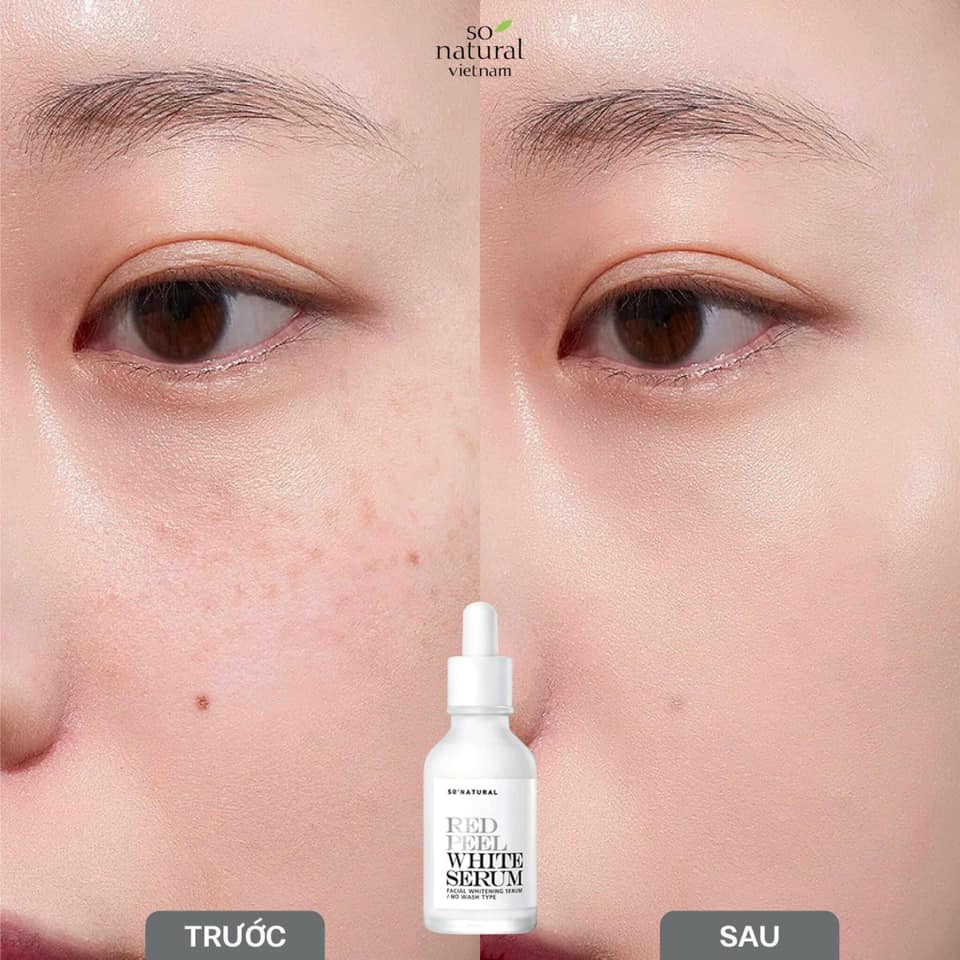 Tinh Chất So.Natural Red Peel White Serum