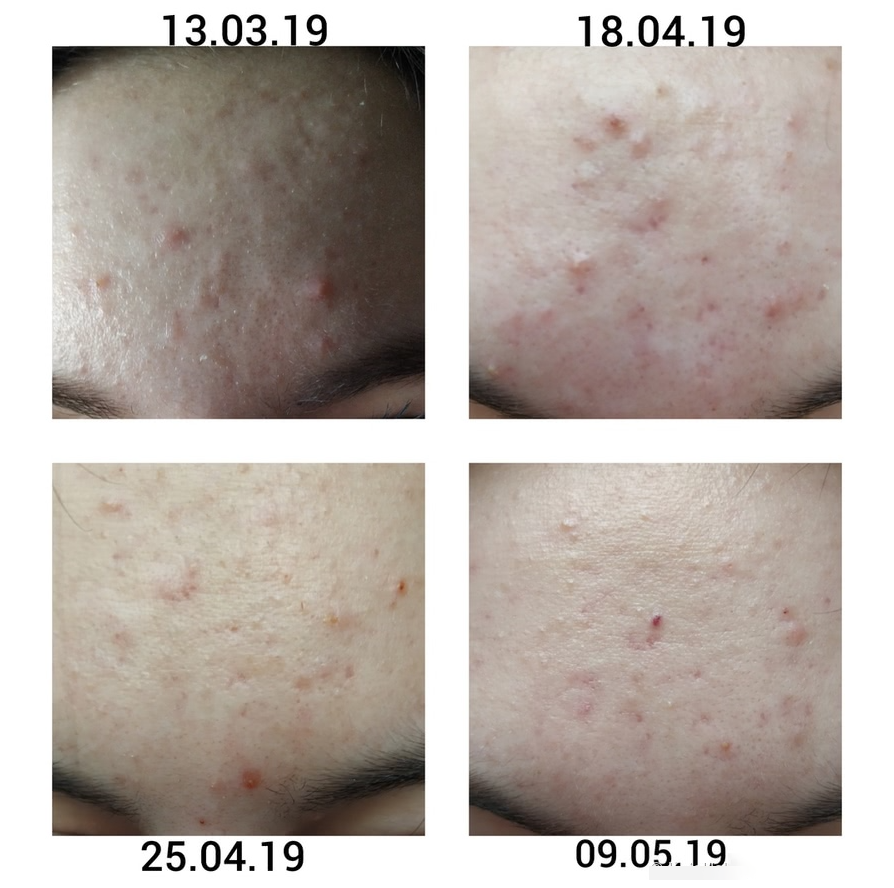 Dung Dịch Tẩy Da Chết Babe Stop AKN Keratolytic Fluid 30ml