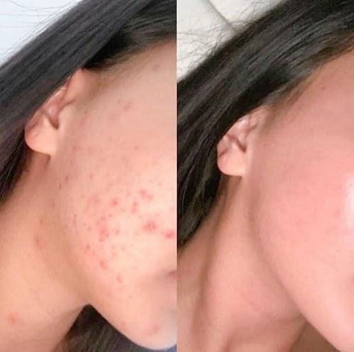 Gel Tẩy Da Chết Paula's Choice 2% BHA Gel Exfoliant 100ml