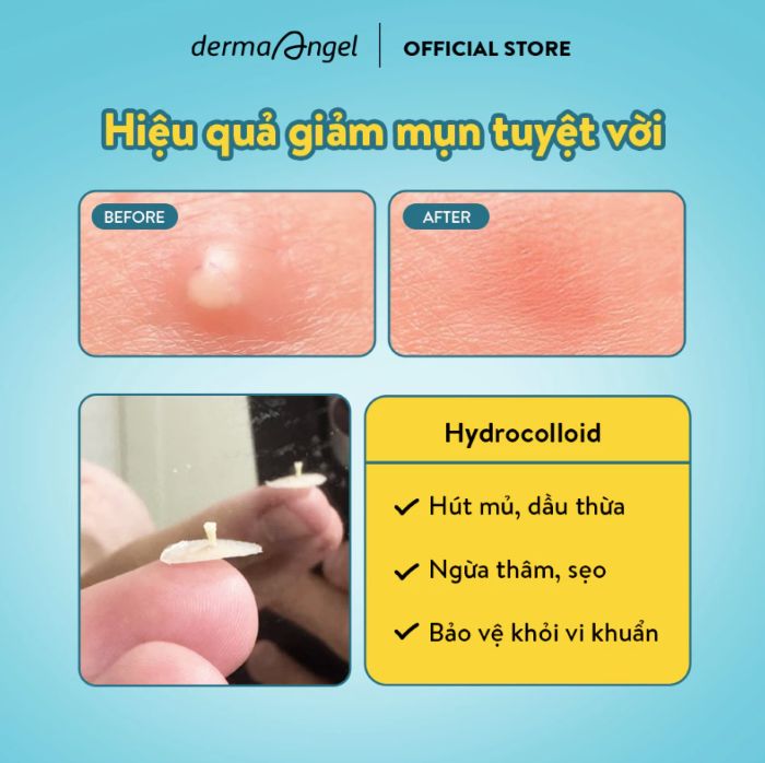 Miếng Dán Mụn Chuyên Biệt Derma Angel Acne Patch 12pcs