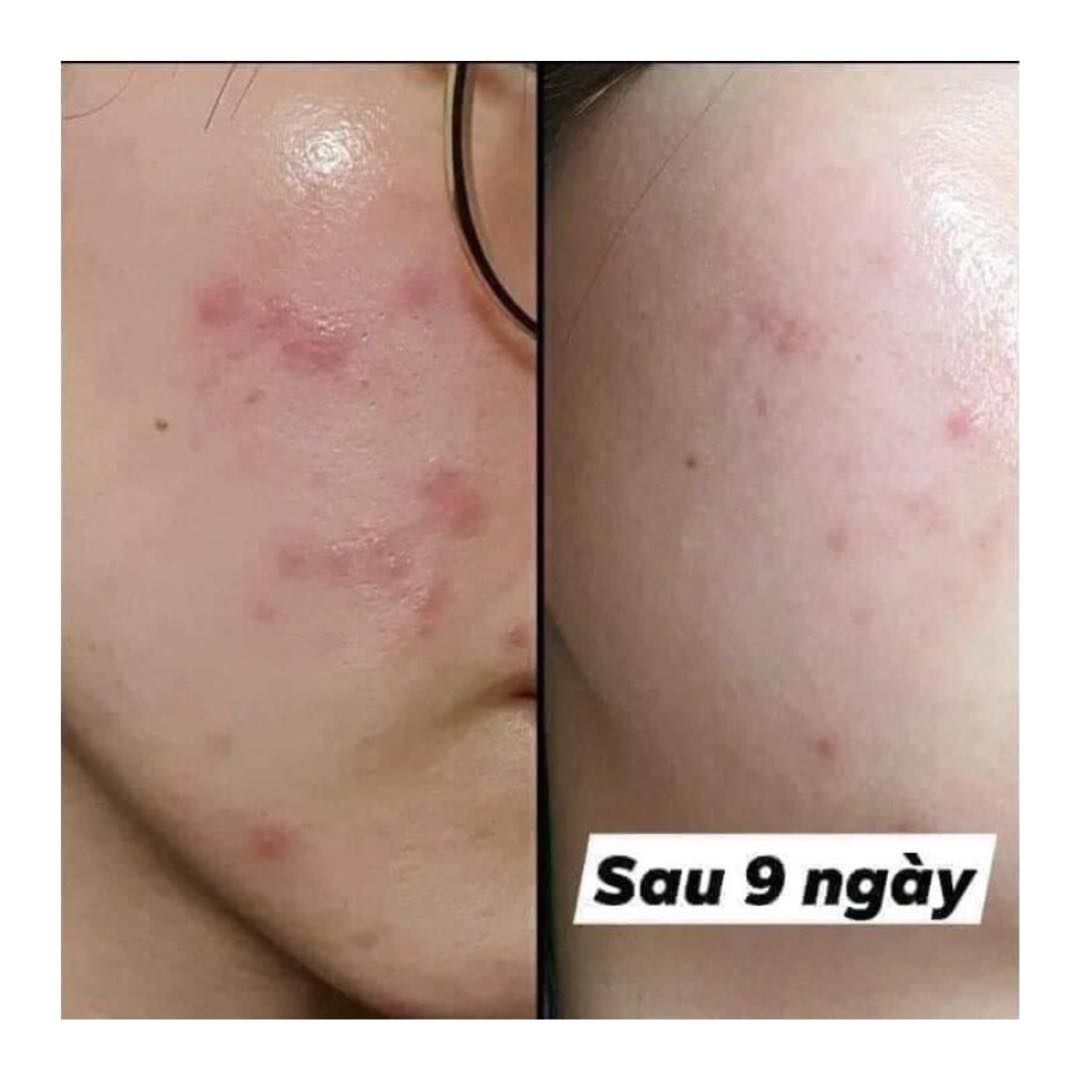 Gel Rửa Mặt Biotrade Acnaut Oxy Wash Cleansing Gel 200ml