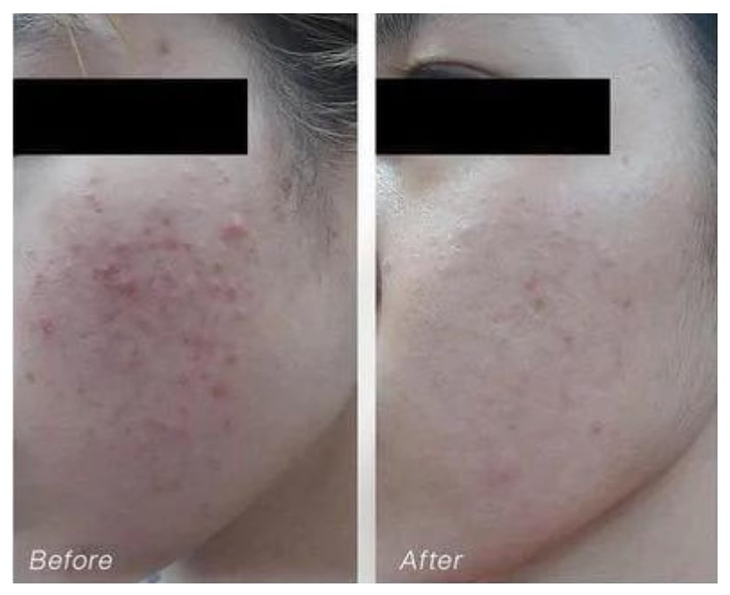 Tinh Chất Ekseption Hyaluronic ZnPCA Mixlab Serum 75ml