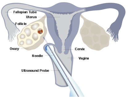 Kỹ Thuật Chọc Hút Noãn Trong Điều Trị Vô Sinh: Quy Trình, Công Nghệ Và Lưu Ý Quan Trọng