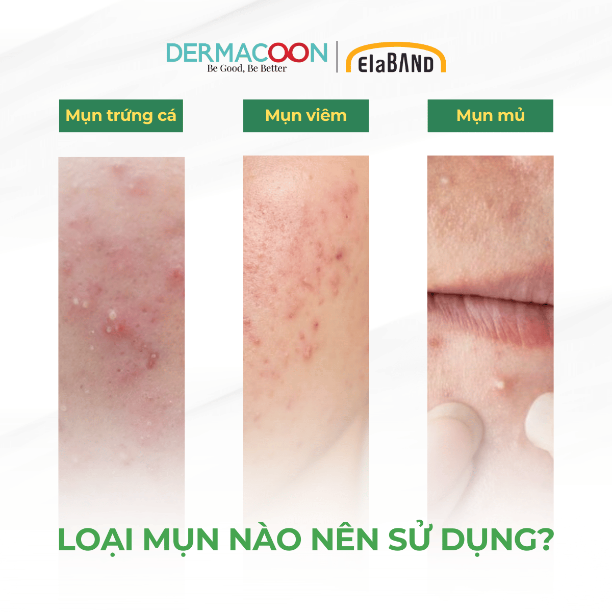 Hộp miếng dán mụn che khuyết điểm và giảm mụn Elaband Hydro Dot Tea Tree ( 3 gói )