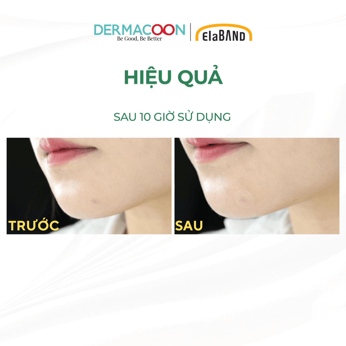 Miếng dán mụn che khuyết điểm và giảm mụn Elaband Hydro Dot Tea Tree (Hộp 23 miếng)