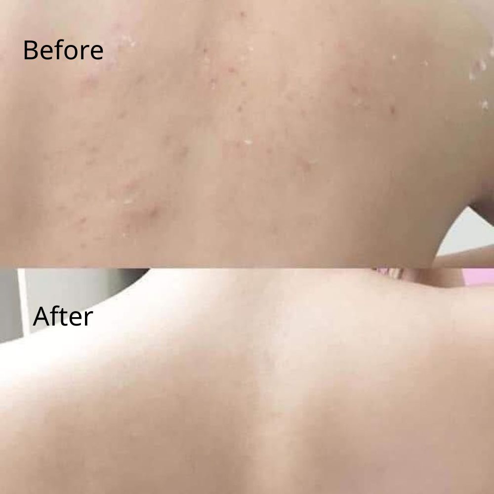 Sữa tắm cho da mụn Medicube Red Acne Body Wash 400ml