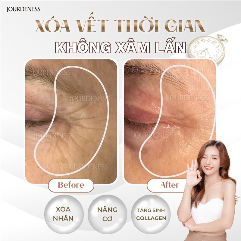 ✨HIFU NÂNG CƠ VÙNG MẮT/ CỔ 45 PHÚT✨